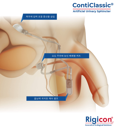 ContiClassic<sup>&reg;</sup> Artificial Urinary Sphincter Product Illustration