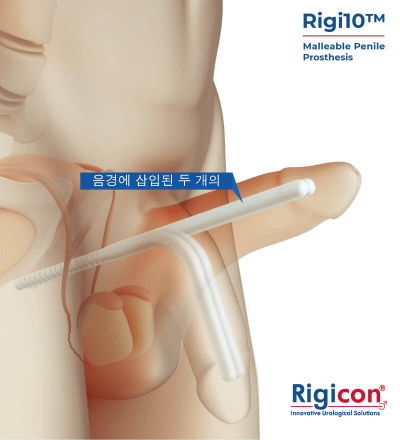 Rigi10™ Malleable Penile Prosthesis Product Illustration